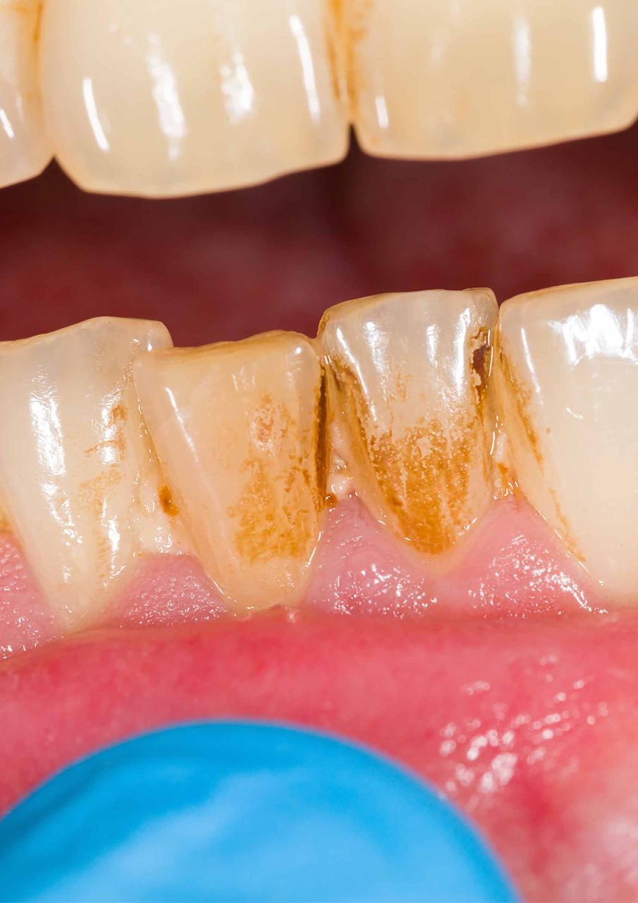 hygiene dentaire professionelle